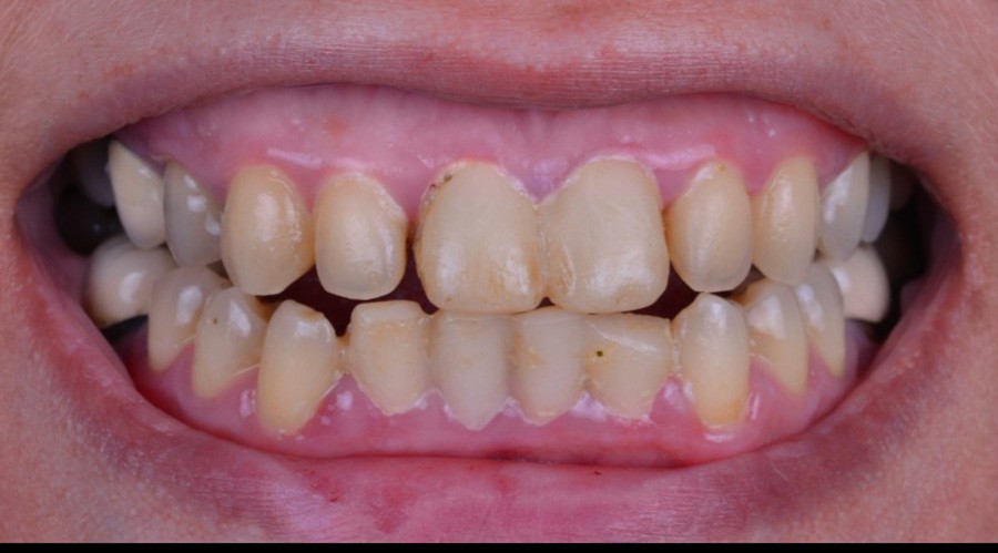 بعد تركيبات-اسنان